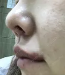 人中短縮 / 口角挙上 清潭女神美容外科 DAY 33 サムネイル用