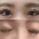 二重埋没 札幌中央形成外科 AFTER サムネイル用