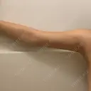 脂肪吸引（二の腕） ドクターフィット（Dr.fit）クリニック DAY 19 サムネイル用