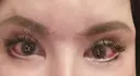 眼瞼下垂（切開） / クマ治療 / 目尻切開 / 下まぶたたるみ取り / 下まぶたの脂肪取り / タレ目形成・グラマラスライン（切開） / 眉下切開 id（アイディ）美容外科 DAY 16 サムネイル用