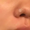 ほくろ・いぼ切除（肌） Mスキンクリニック DAY 47 サムネイル用