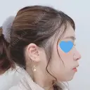 鼻中隔延長（切開） / 軟骨移植 / 鼻尖縮小 HANABI整形外科 DAY 73 サムネイル用