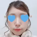 鼻中隔延長（切開） / 軟骨移植 / 鼻尖縮小 HANABI整形外科 DAY 73 サムネイル用