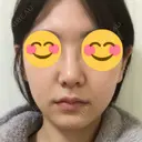 鼻尖形成（切開） / 鼻中隔延長（切開） / 小鼻縮小（切開） / 軟骨移植 / ワシ鼻修正・ハンプ切除 / 鼻尖縮小 カイ整形外科・皮膚科 DAY 16 サムネイル用