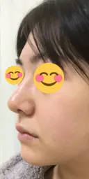 鼻尖形成（切開） / 鼻中隔延長（切開） / 小鼻縮小（切開） / 軟骨移植 / ワシ鼻修正・ハンプ切除 / 鼻尖縮小 カイ整形外科・皮膚科 DAY 16 サムネイル用
