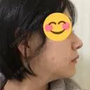 鼻尖形成（切開） / 鼻中隔延長（切開） / 小鼻縮小（切開） / 軟骨移植 / ワシ鼻修正・ハンプ切除 / 鼻尖縮小 カイ整形外科・皮膚科 DAY 16 サムネイル用