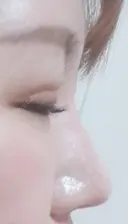 眼瞼下垂（切開） / 隆鼻術 / 鼻尖形成（切開） / 鼻中隔延長（切開） / 軟骨移植 アネシス美容クリニック DAY 17 サムネイル用