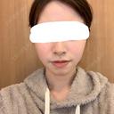 脂肪溶解注射（顔） 赤坂プレミアクリニック DAY 12 サムネイル用