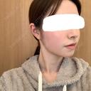 脂肪溶解注射（顔） 赤坂プレミアクリニック DAY 12 サムネイル用