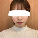 脂肪溶解注射（顔） 赤坂プレミアクリニック DAY 13 サムネイル用