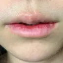 口唇縮小術 / PRP皮膚再生療法 品川美容外科 品川院 DAY 9 サムネイル用