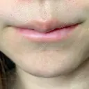 口唇縮小術 / PRP皮膚再生療法 品川美容外科 品川院 DAY 9 サムネイル用