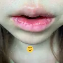 口唇縮小術 / PRP皮膚再生療法 品川美容外科 品川院 DAY 9 サムネイル用