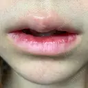 口唇縮小術 / PRP皮膚再生療法 品川美容外科 品川院 DAY 10 サムネイル用