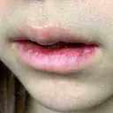 口唇縮小術 / PRP皮膚再生療法 品川美容外科 品川院 DAY 10 サムネイル用