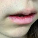 口唇縮小術 / PRP皮膚再生療法 品川美容外科 品川院 DAY 10 サムネイル用