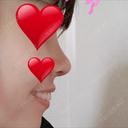 隆鼻術 / 鼻尖形成（切開） / 鼻中隔延長（切開） / 眉間プロテーゼ FROM B整形外科 (旧バウム整形外科) DAY 14 サムネイル用