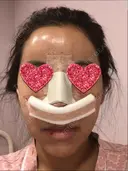 鼻中隔延長（切開） / 小鼻縮小（切開） / 骨切幅寄せ / 水光注射（ハリ・美肌） 韓国BBクリニック（旧 シンミアン形成外科） DAY 0 サムネイル用