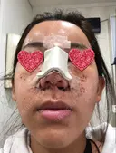 鼻中隔延長（切開） / 小鼻縮小（切開） / 骨切幅寄せ / 水光注射（ハリ・美肌） 韓国BBクリニック（旧 シンミアン形成外科） DAY 1 サムネイル用