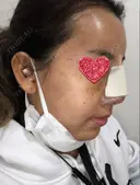 鼻中隔延長（切開） / 小鼻縮小（切開） / 骨切幅寄せ / 水光注射（ハリ・美肌） 韓国BBクリニック（旧 シンミアン形成外科） DAY 1 サムネイル用