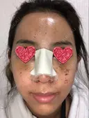 鼻中隔延長（切開） / 小鼻縮小（切開） / 骨切幅寄せ / 水光注射（ハリ・美肌） 韓国BBクリニック（旧 シンミアン形成外科） DAY 1 サムネイル用