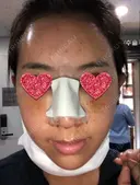 鼻中隔延長（切開） / 小鼻縮小（切開） / 骨切幅寄せ / 水光注射（ハリ・美肌） 韓国BBクリニック（旧 シンミアン形成外科） DAY 2 サムネイル用