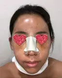 鼻中隔延長（切開） / 小鼻縮小（切開） / 骨切幅寄せ / 水光注射（ハリ・美肌） 韓国BBクリニック（旧 シンミアン形成外科） AFTER サムネイル用