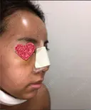 鼻中隔延長（切開） / 小鼻縮小（切開） / 骨切幅寄せ / 水光注射（ハリ・美肌） 韓国BBクリニック（旧 シンミアン形成外科） DAY 3 サムネイル用