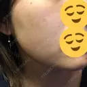 美肌レーザー / 再生医療 / シミ取りレーザー / 美白レーザー KM銀座クリニック DAY 9 サムネイル用