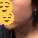 美肌レーザー / 再生医療 / シミ取りレーザー / 美白レーザー KM銀座クリニック DAY 9 サムネイル用