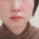 小鼻縮小（切開） / 鼻尖縮小 表参道スキンクリニック 表参道院 DAY 88 サムネイル用