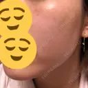 美肌レーザー / 再生医療 / シミ取りレーザー / 美白レーザー KM銀座クリニック DAY 11 サムネイル用