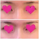 その他（鼻） / 糸リフト / 鼻修正 / ヒアルロン酸注入（額） Beauty Clinic the GINZA DAY 0 サムネイル用