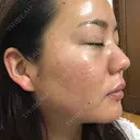 ニキビ治療 たにまちクリニック DAY 171 サムネイル用