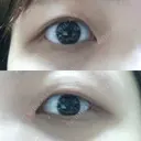 脂肪溶解注射（まぶた） 湘南美容クリニック 高松院 AFTER サムネイル用