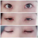 二重埋没 / 眼瞼下垂（切開） / クマ治療 / 下まぶたの脂肪取り THE MEDICAL SALON DAY 54 サムネイル用