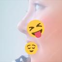隆鼻術 / 鼻尖形成（切開） / 鼻中隔延長（切開） / 眉間プロテーゼ FROM B整形外科 (旧バウム整形外科) DAY 15 サムネイル用