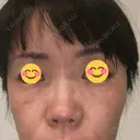 下まぶたたるみ取り / PRP皮膚再生療法 RDクリニック大阪 DAY 7 サムネイル用