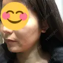 骨削り（エラ） / 骨削り（頬） / 脂肪吸引（顔） View美容整形外科 DAY 72 サムネイル用