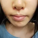 人中短縮 CLASSY 仙台美容外科・美容皮膚科 DAY 15 サムネイル用