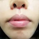 人中短縮 CLASSY 仙台美容外科・美容皮膚科 DAY 15 サムネイル用