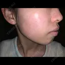 シミ取りレーザー / フォトRF 木本整形外科クリニック アンチエイジング美容外来センター DAY 9 サムネイル用