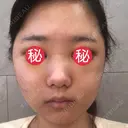 骨削り（頬） RG整形外科（旧リオン整形外科） DAY -394 サムネイル用