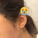 骨削り（頬） RG整形外科（旧リオン整形外科） DAY -394 サムネイル用