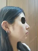二重埋没 / 小鼻縮小（切開） / その他（鼻） / 骨切り（あご） / 軟骨移植 バノバギ整形外科 AFTER サムネイル用