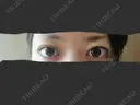 二重埋没 / 小鼻縮小（切開） / その他（鼻） / 骨切り（あご） / 軟骨移植 バノバギ整形外科 DAY 28 サムネイル用
