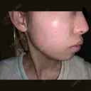 シミ取りレーザー / フォトRF 木本整形外科クリニック アンチエイジング美容外来センター AFTER サムネイル用