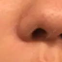 ほくろ・いぼ切除（肌） Mスキンクリニック DAY 52 サムネイル用