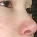 隆鼻術 / 鼻中隔延長（切開） 牧野皮膚科形成外科内科医院 美容外科・形成外科・抗加齢医学外来 DAY 394 サムネイル用