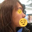 鼻尖形成（切開） / 鼻中隔延長（切開） / 小鼻縮小（切開） / 軟骨移植 / 骨切幅寄せ HANABI整形外科 DAY 287 サムネイル用